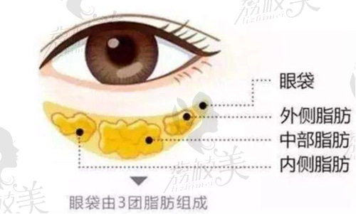 何祥龙医生做外切去眼袋能改善眼周问题