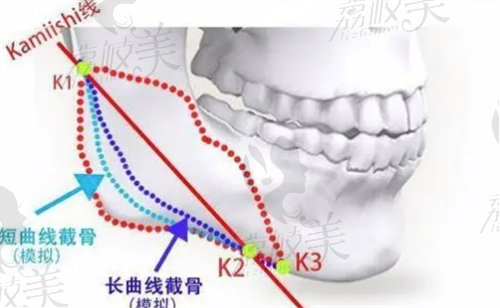 长曲线截骨术的部位