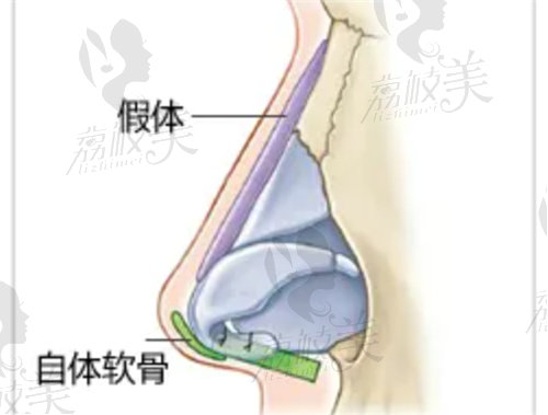 上海美莱开展的关于隆鼻项目有哪些
