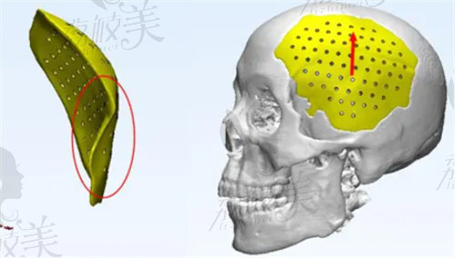 peek顱骨修補材料修復(fù)顱骨缺損