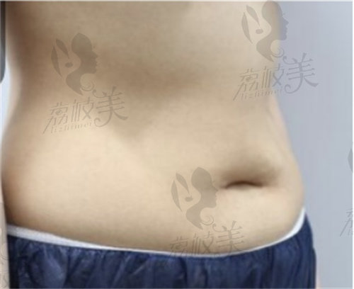 韩国欧佩拉朴延涉院长腰腹吸脂术前示意图