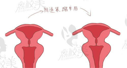 上海阴道紧缩手术医院排名汇总