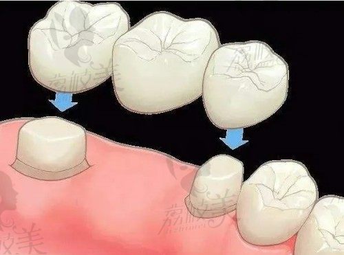 牙冠修复：烤瓷牙/全瓷牙
