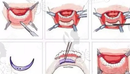 正颌手术流程