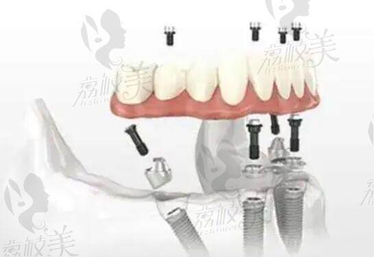 西安交大口腔和四医大口腔种植牙优势