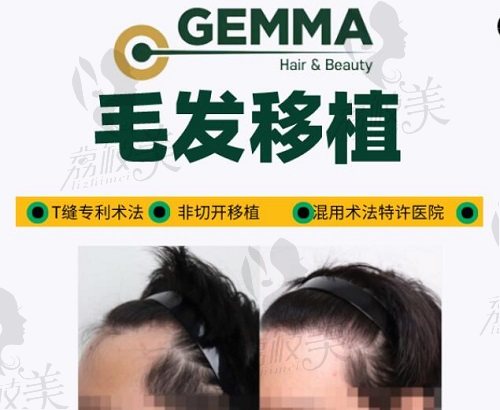 韩国GEMMA毛发移植中心植发对比