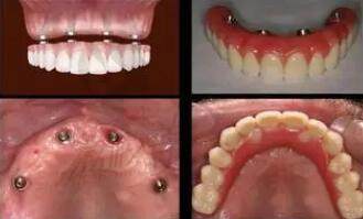 全口牙齿缺失治疗过程及结果