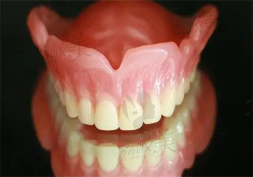 吸附性义齿和种植牙哪个好
