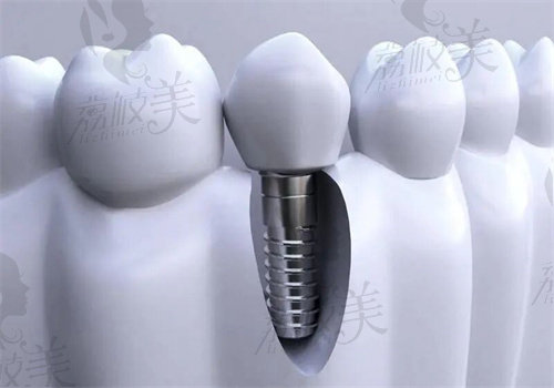 吸附性义齿和种植牙区别