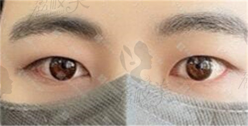 韩国来丽双眼皮改单眼皮术后10天