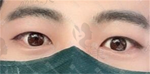 韩国来丽双眼皮改单眼皮术后1个月
