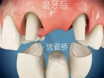 牙齿修复方式