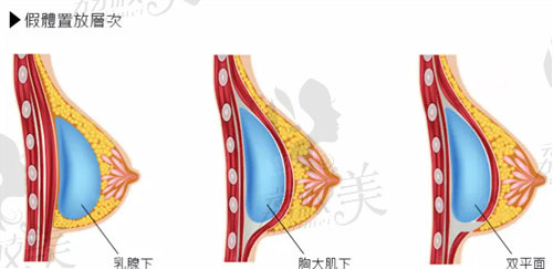 廣州美恩許揚(yáng)濱醫(yī)生隆胸假體放入的位置