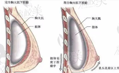 廣州美恩許揚(yáng)濱醫(yī)生隆胸將假體放置的位置