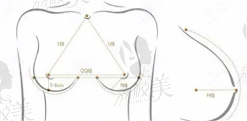 广州美恩许扬滨医生隆胸技术的胸型设计