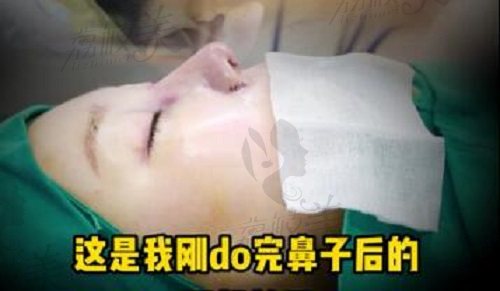 深圳富华高静医生隆鼻术后即刻