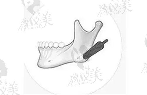 何晋龙医生做下颌角截骨技术优势