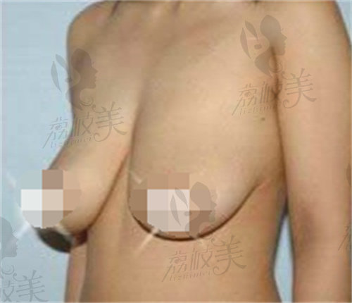 薛瑞医生做乳房下垂矫正手术术前