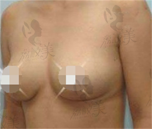 薛瑞医生做乳房下垂矫正手术术后实例反馈
