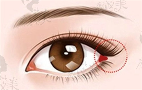 魏志香医生做外眼角修复手术的优势