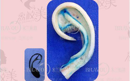 康春雨医生雕刻的耳软骨支架照