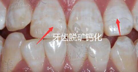 牙齿脱矿钙化的表现