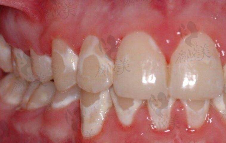 牙齿钙化是什么意思