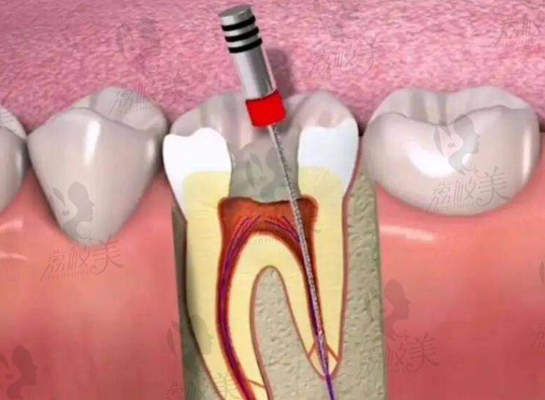 牙齿钙化做不了根管治疗怎么办