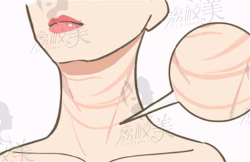 韩国延世多仁整形外科颈纹展示