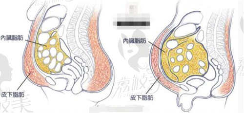 馮斌吸脂示意圖