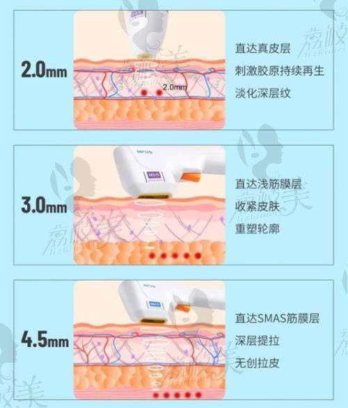 武汉艺星做超声炮怎么样？