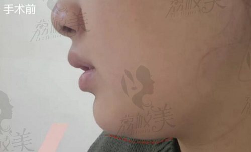 郑渊豪院长面部吸脂术前 郑渊豪院长面部吸脂术前