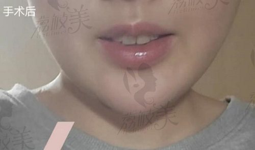 郑渊豪院长面部吸脂术后 郑渊豪院长面部吸脂术后