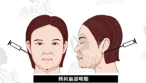 面部吸脂漫画 面部吸脂漫画