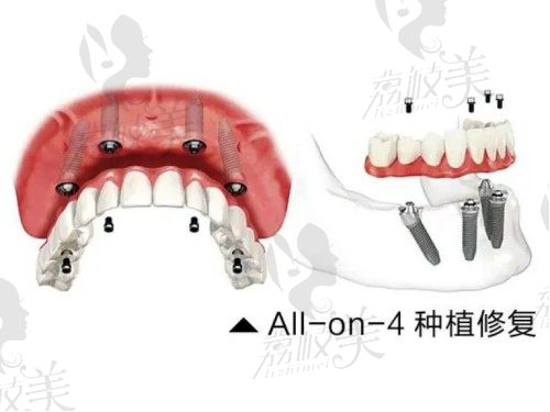 三亚雅福口腔all-on-4种植技术
