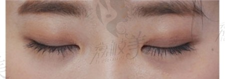 厦门薇格陈丽平双眼皮修复技术不错