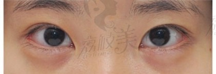 厦门薇格陈丽平医生双眼皮修复技术娴熟