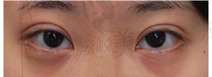 陈丽平双眼皮修复怎么样