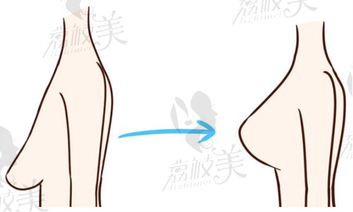 杭州乳房下垂上提手术哪里好？