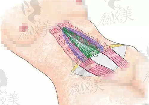 腹壁整形手术的韩国推荐医院名单