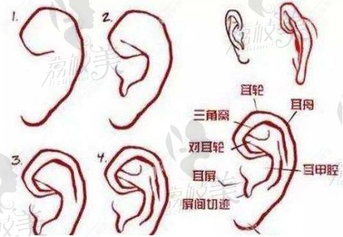 重庆松山医院张朝梅扩张法耳再造手术