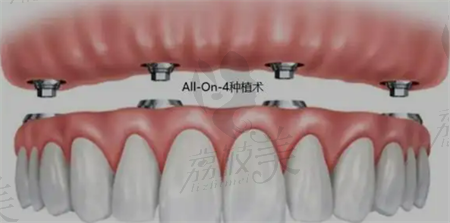 北京三十二贝口腔种植牙