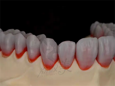 牙齿贴面的操作流程