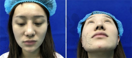 鼻中隔偏曲手术失败实例图