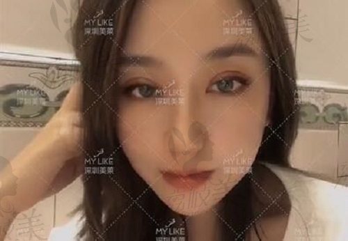 深圳美莱陈磊做眼整形失败修复术后