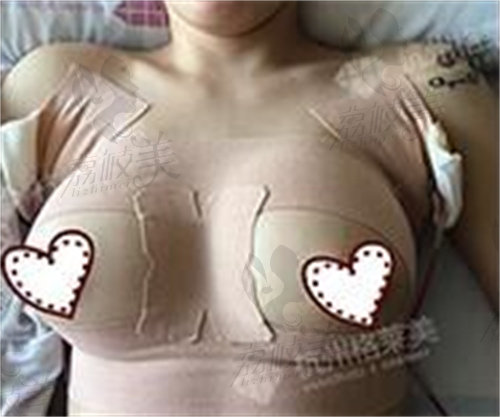 杭州夏文豪隆胸技术可靠