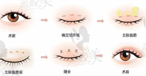 南京艺星吕永全做双眼皮的流程示意图