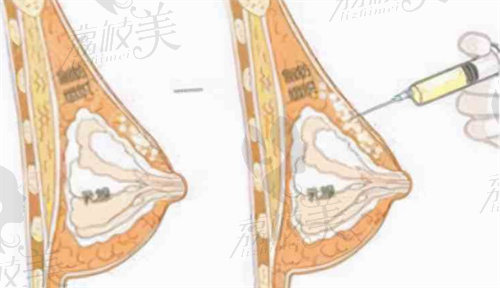 南京美莱张荣明医生隆胸注射角度