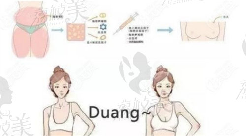 南京美莱张荣明医生自体脂肪隆胸的流程示意图