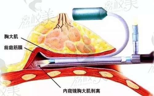 南京美莱夏建军隆胸的技术